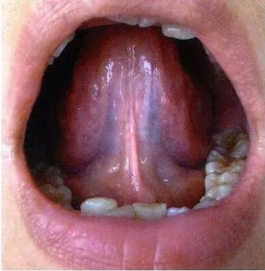 舌下结构图片