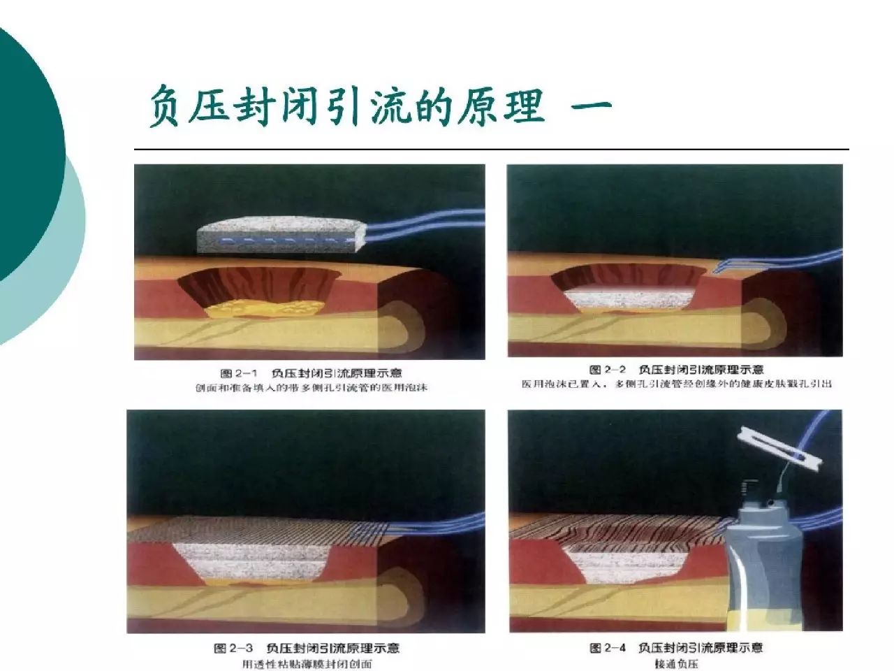 vsd引流术是什么图片