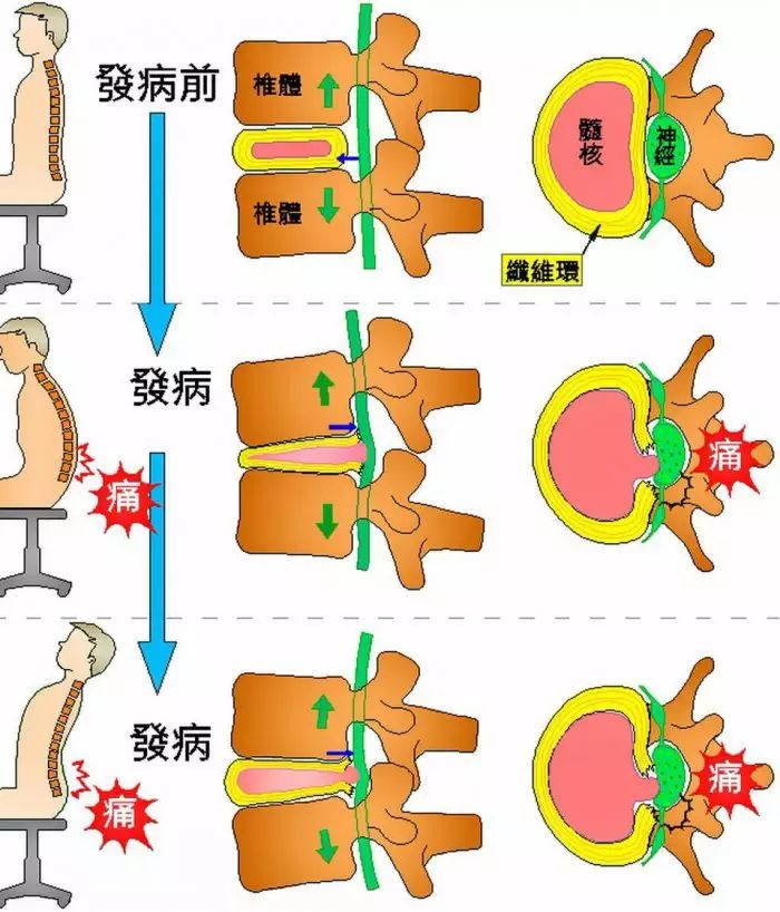 在脊椎骨之间(如图示椎体中间的区块)都有一块类似于缓冲软垫的部位就