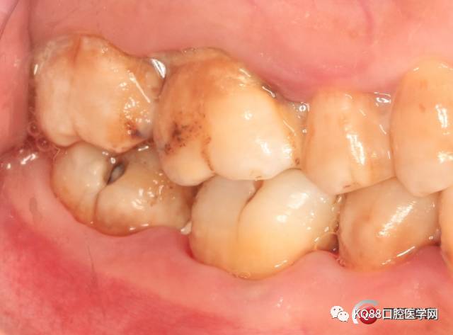 牙瘤钙化图片
