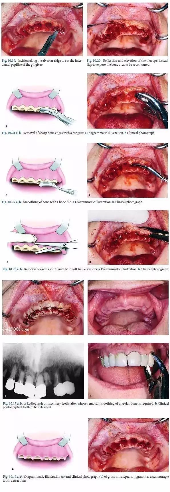 冠周龈瓣切除术图片