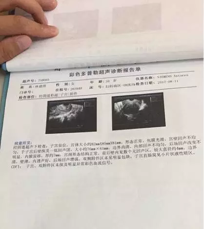 子宫肌瘤住院病历图片图片
