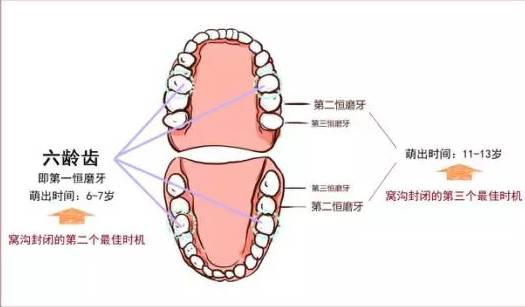 11-13岁时,第二恒磨牙萌出后第一恒磨牙也叫六龄齿,窝沟很多,此时有些