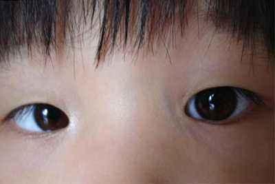 儿童倒睫毛症状图片
