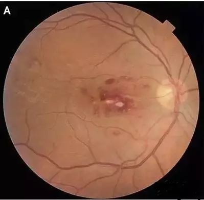 眼底硬性渗出图片