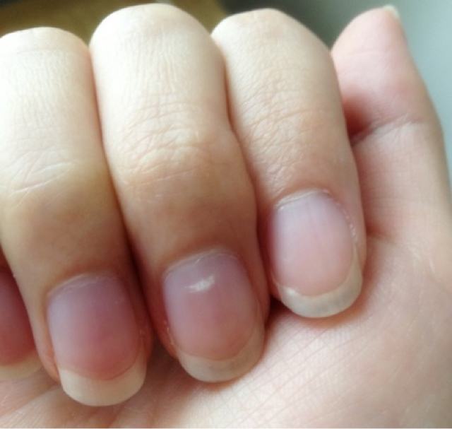 指甲上发出的那些微妙信号,是什么正在残蚀你的肾?