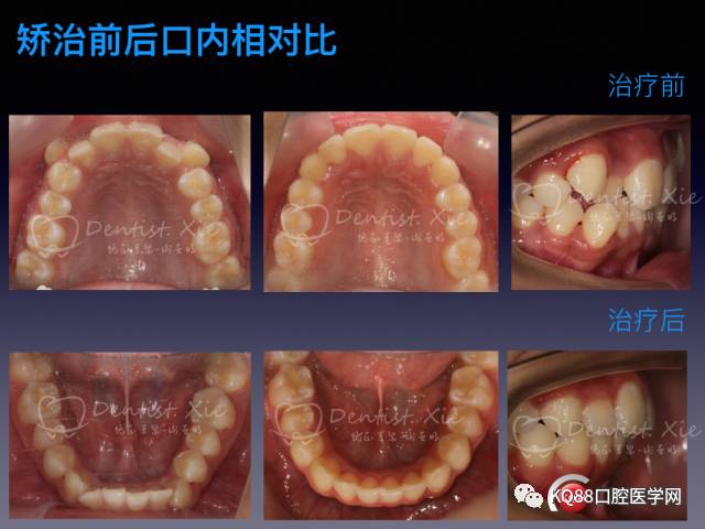 正畸之始始与思考一例中重度牙列拥挤的病例带来的思考