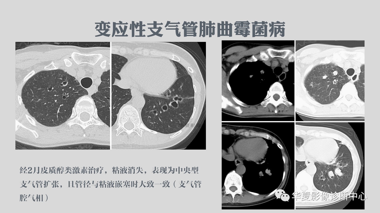 滿滿的經驗侵襲性肺麴黴菌病例追蹤ct影像表現