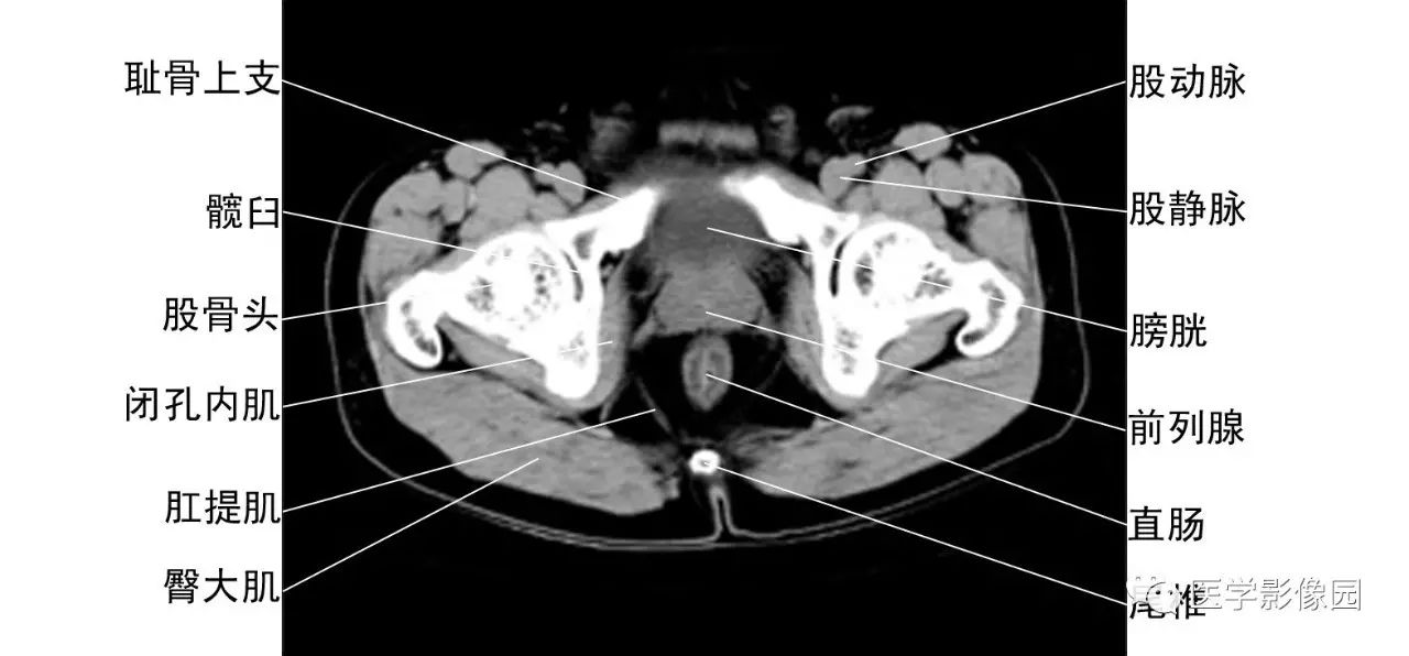 男性泌尿系统解剖图ct图片