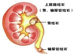 治疗感染性肾结石有3个食疗方