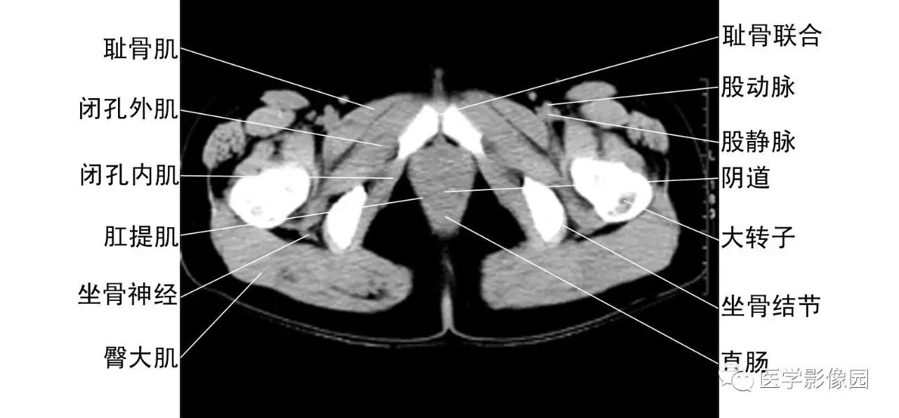 男性泌尿系统解剖图ct图片