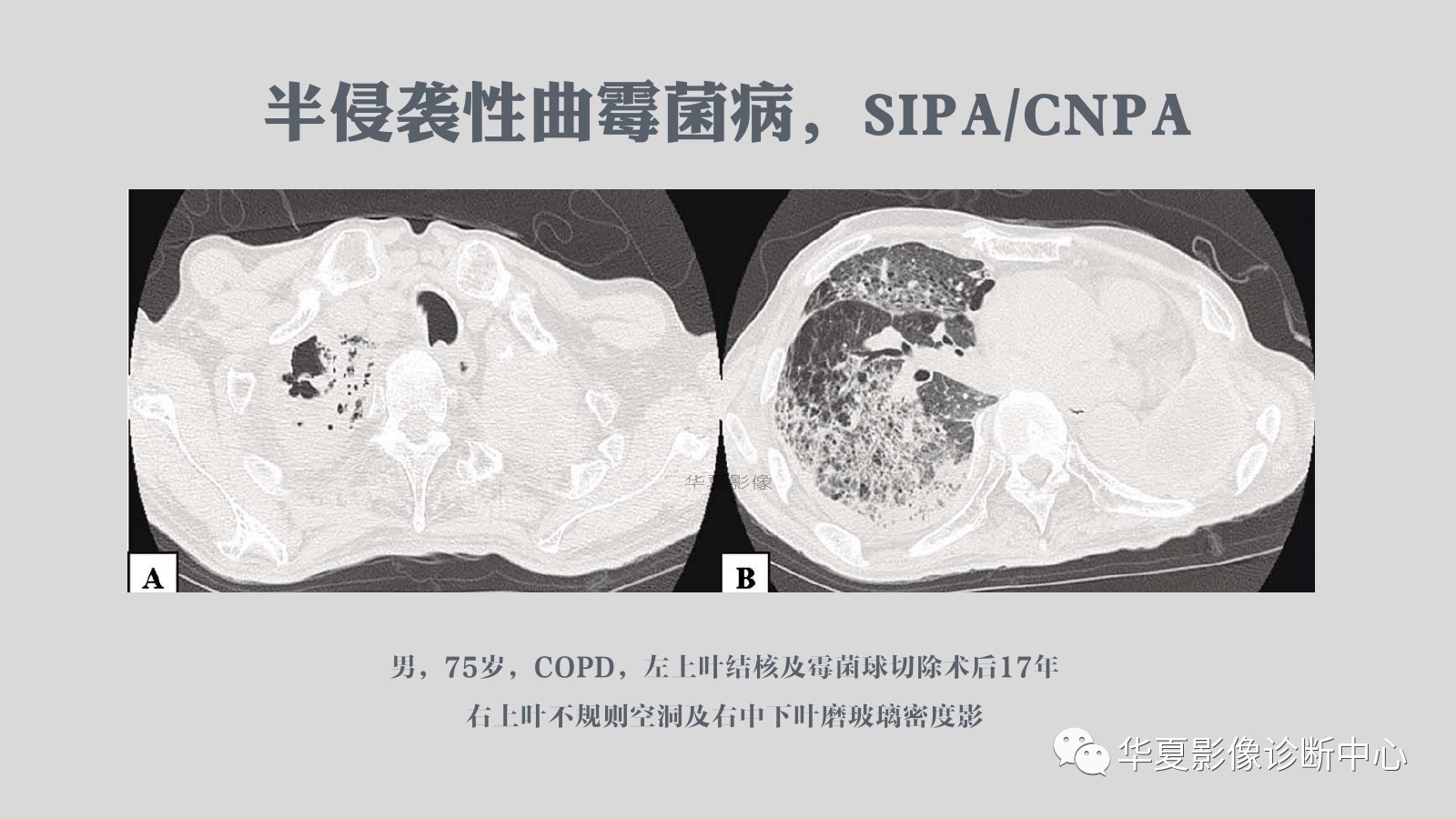 滿滿的經驗侵襲性肺麴黴菌病例追蹤ct影像表現