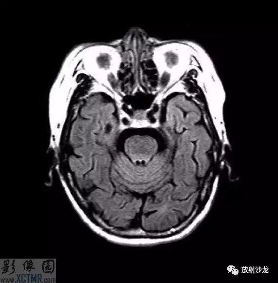 正中矢狀位 t1wi mr 成像.