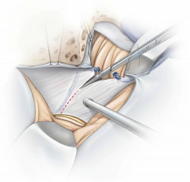 標準經巖骨後方入路操作技巧丨the neurosurgical atlas全文翻譯