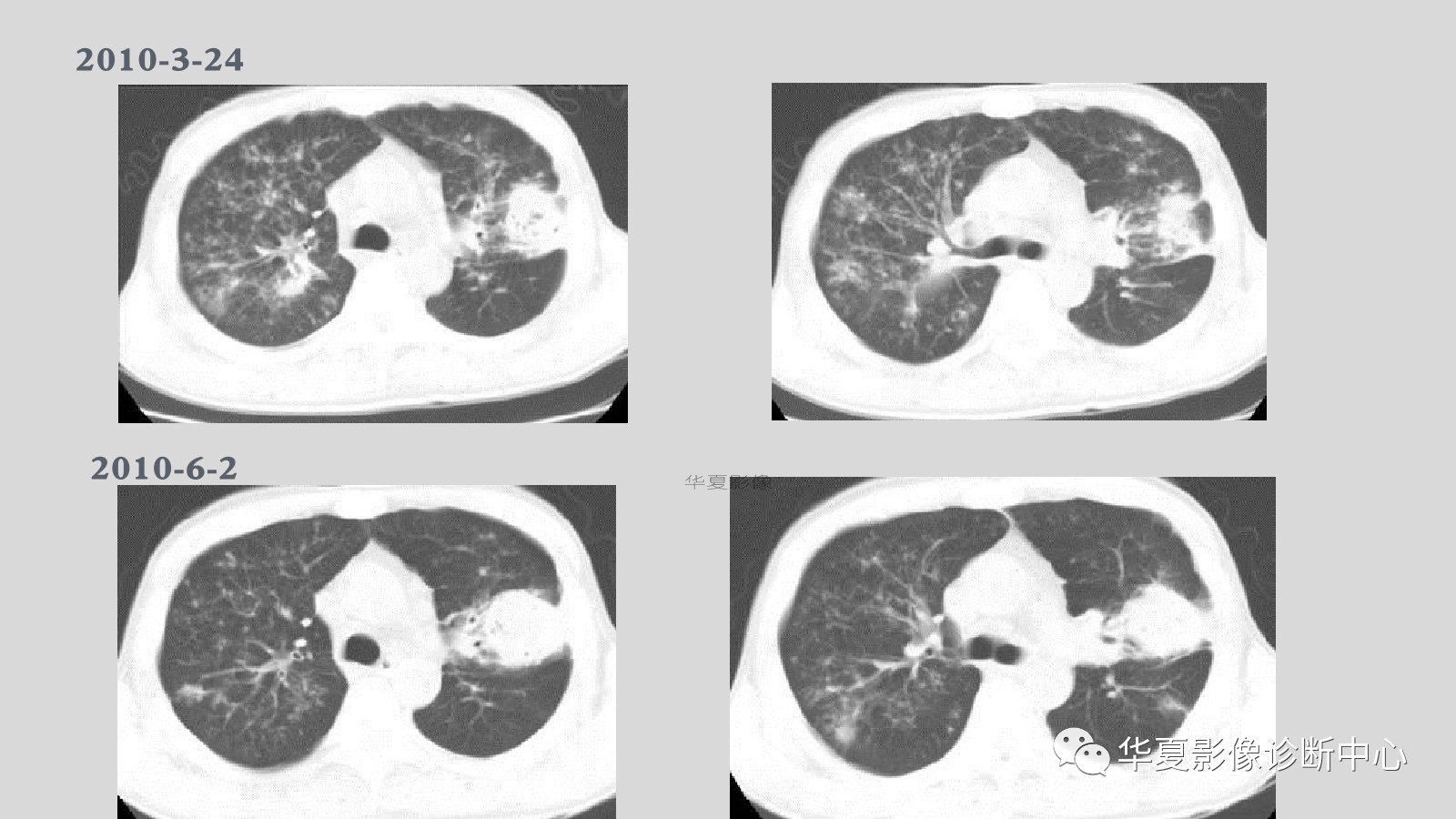 满满的经验侵袭性肺曲霉菌病例追踪ct影像表现