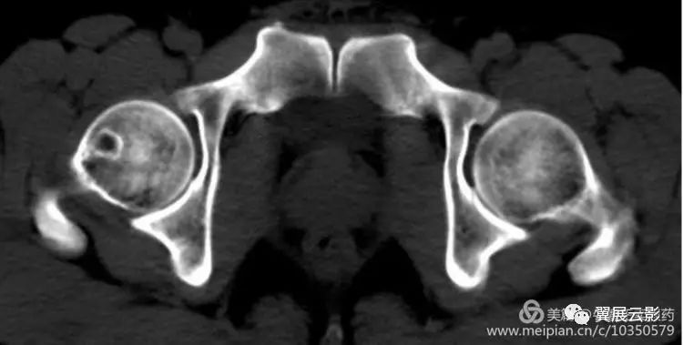 股骨颈疝窝(滑膜疝凹)于1982年由pitt等首先报道