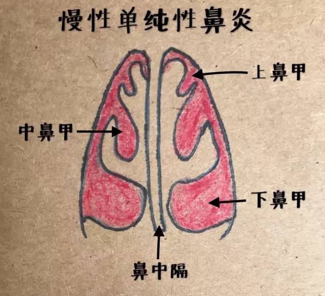 正常鼻甲图图片