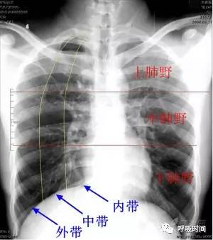 定位:因为肺叶,肺段相互之间有重叠,所以仅有正位片时,除肺尖部病变