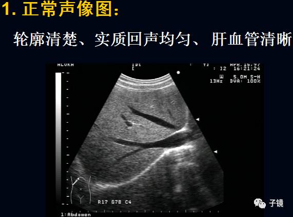 肝右叶超声测量图片图片