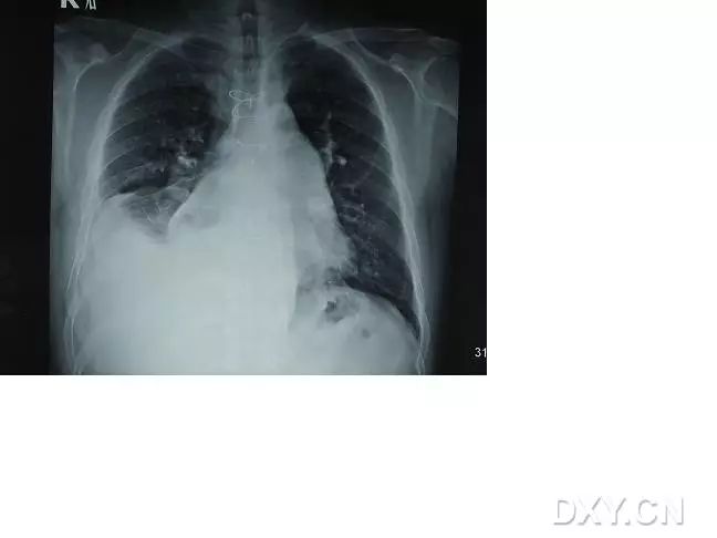右侧胸腔积液图片