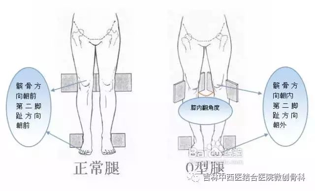 這種o型腿俗稱