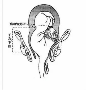 肩先露容易导致宫缩乏力和胎膜早破