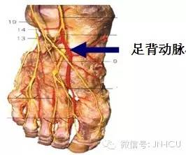 足背动脉搏动准确定位,使动脉恰在手指下方,在食指下动脉搏动处进针