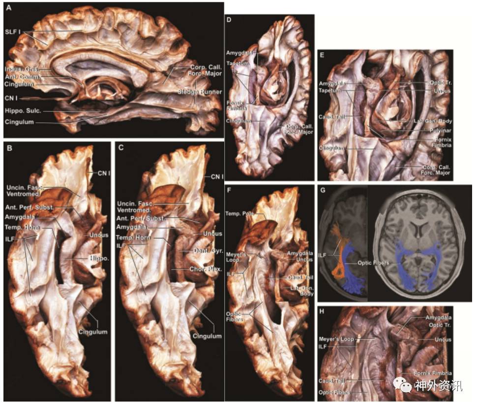 大腦半球內側面及底面的纖維束解剖