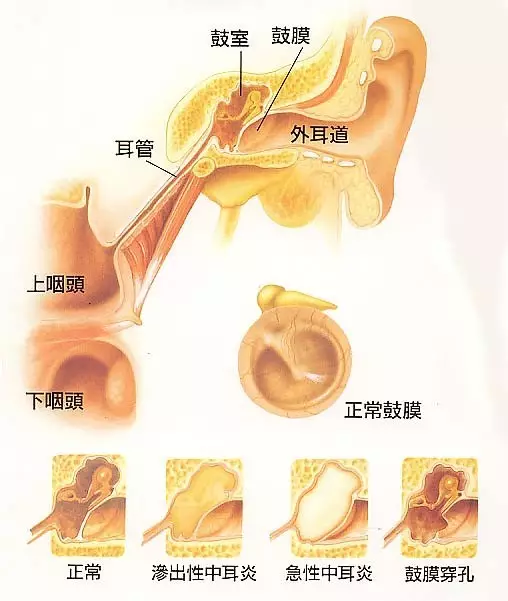 中耳炎六大誤區,久病不治損聽力!—溫州助聽器