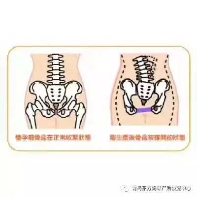 產後恢復根本問題——盆骨閉合