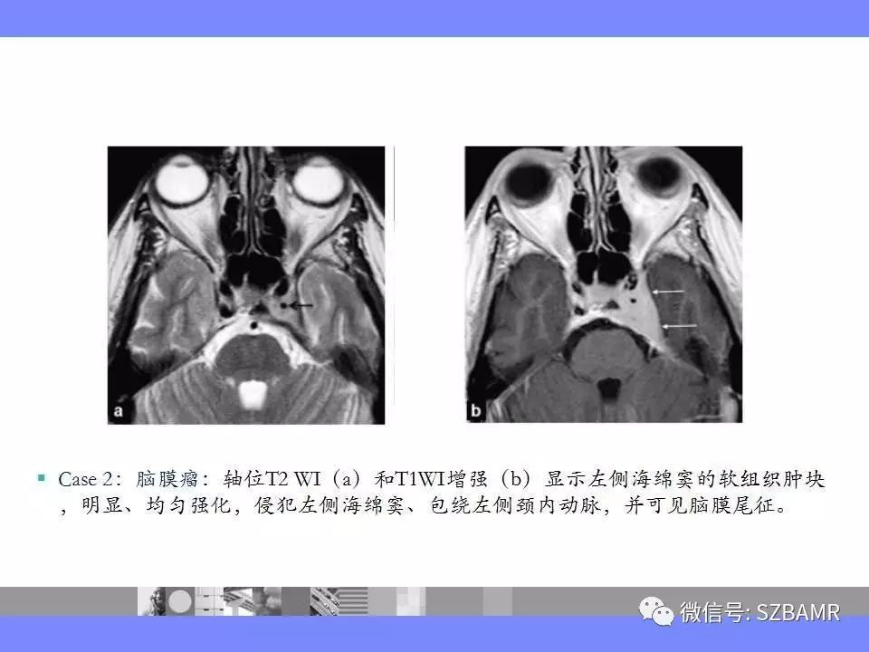 海绵窦磁共振解剖图图片