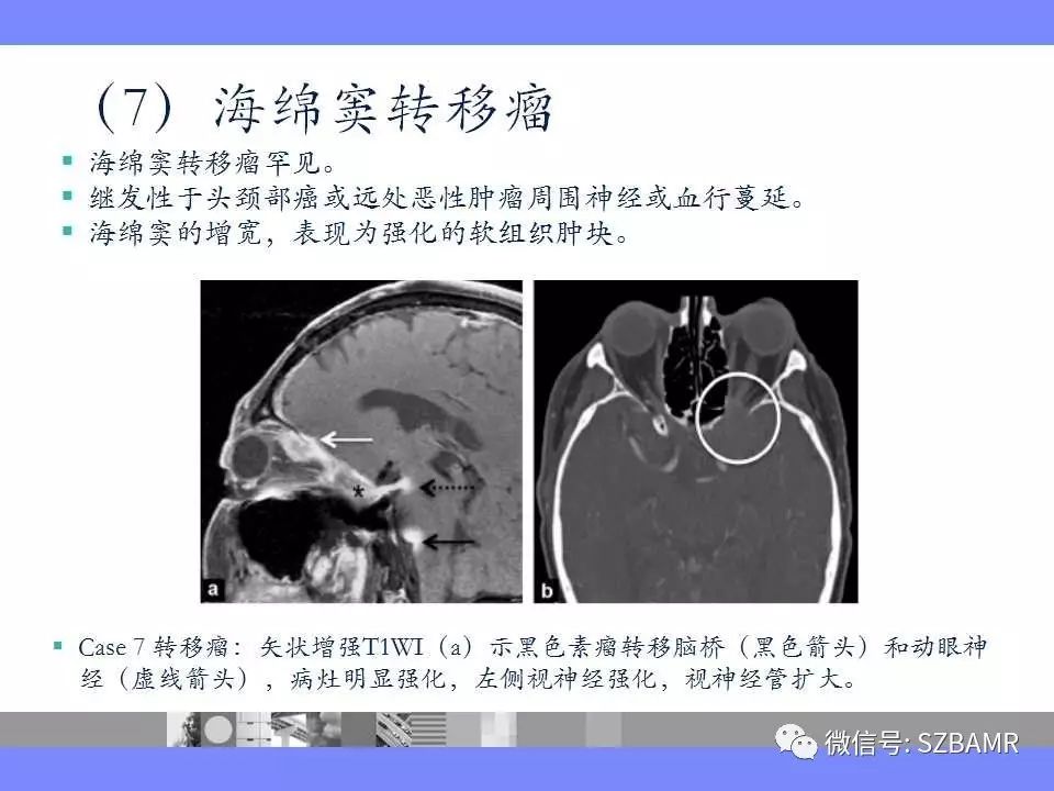 海绵窦磁共振解剖图图片