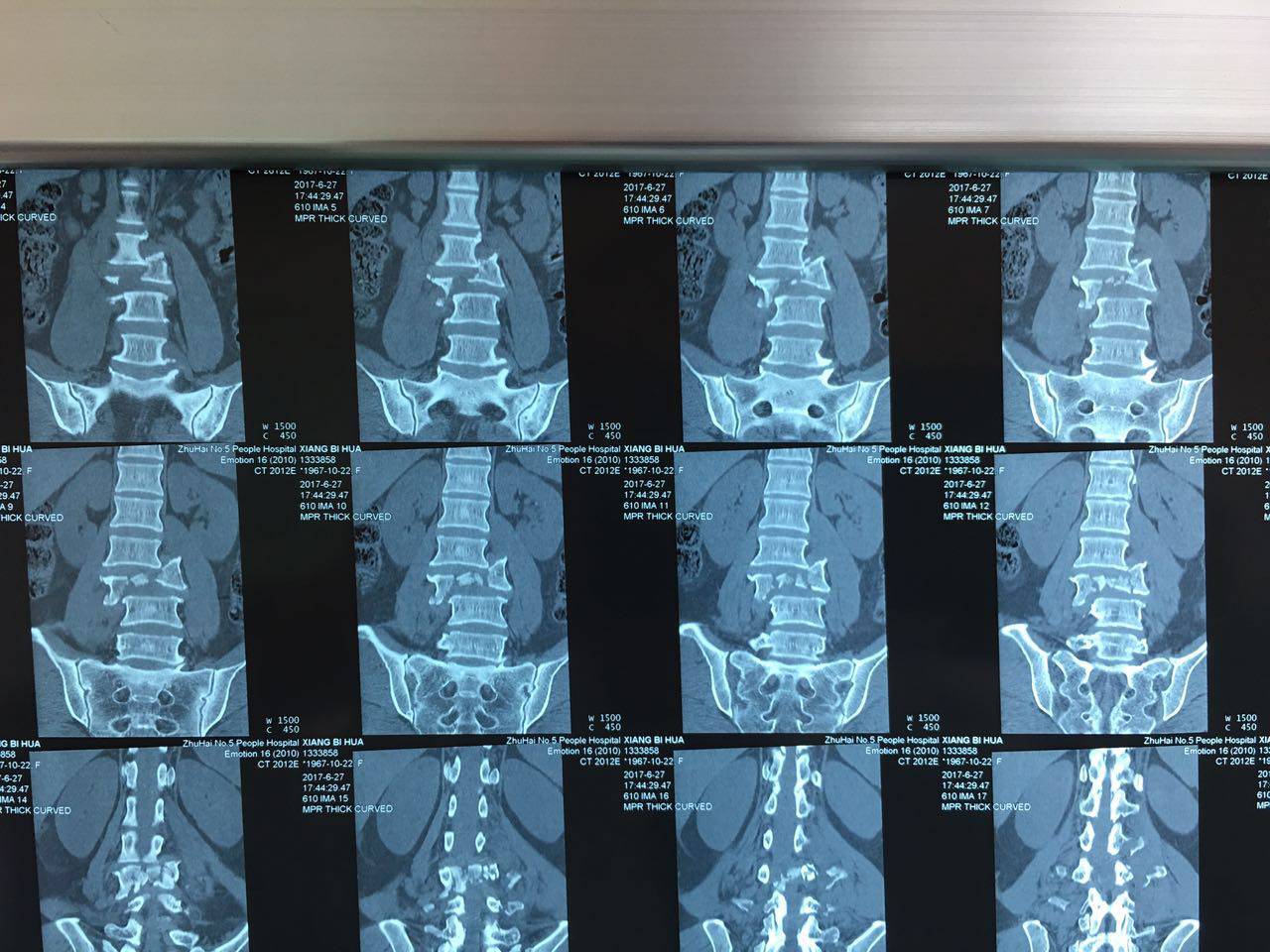 发现患者腰3椎体爆裂性骨折伴脱位