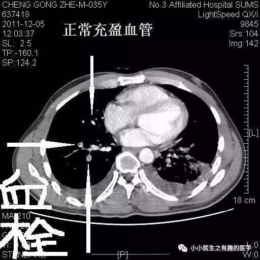 肺栓塞ct輕鬆入門我整理的經典圖譜學不會我拜你為師