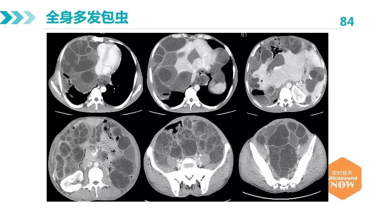 包虫病的影像学特点