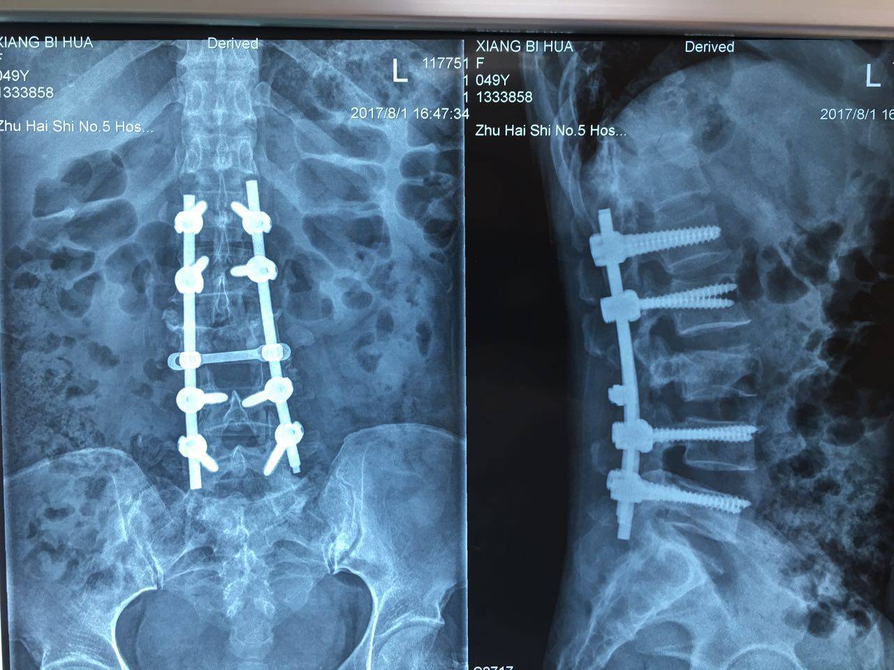 患者傷情較重無法取得側位片)經檢查,發現患者腰3椎體爆裂性骨折伴