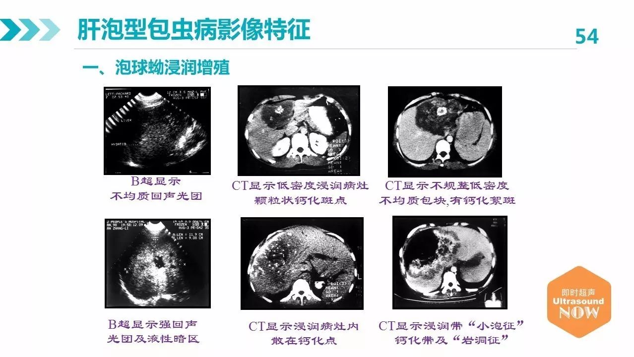 granulosa是人体感染细粒棘球绛虫的幼虫所致的疾病,又称为囊型包虫病