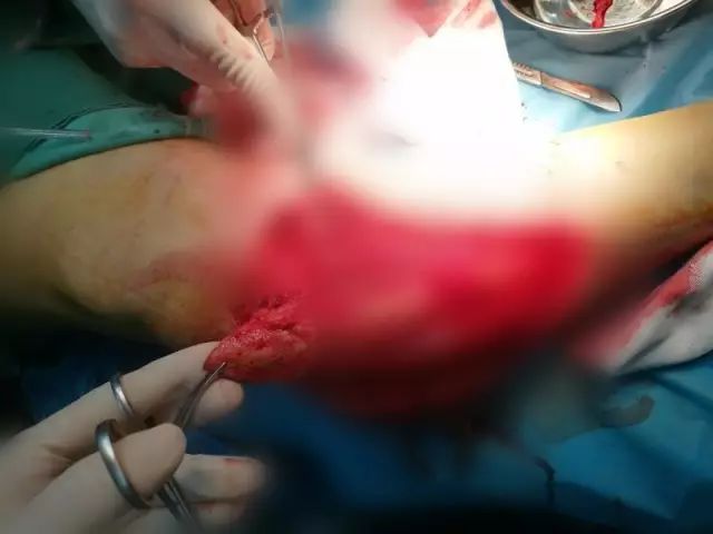 截肢手术全过程图片