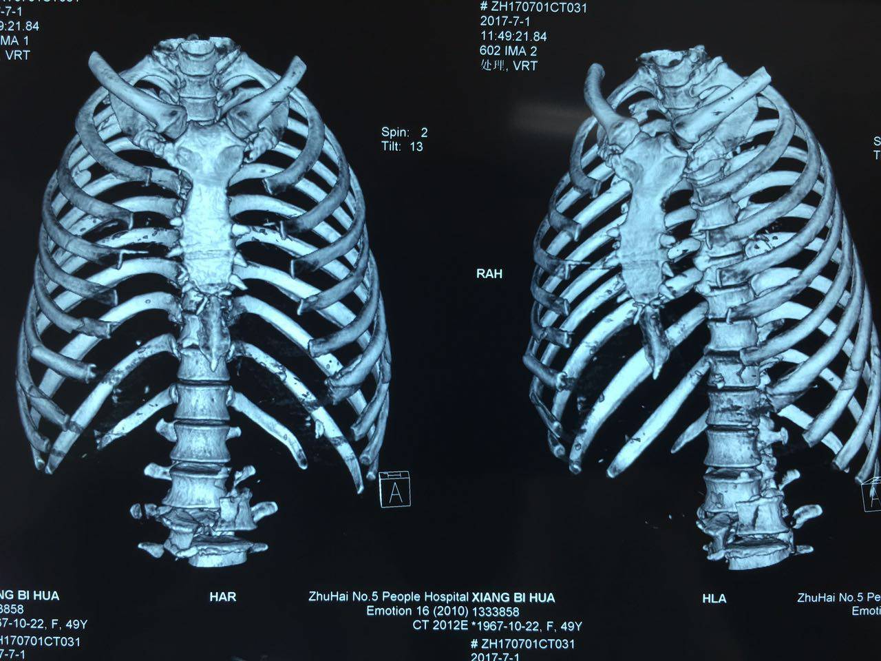 发现患者腰3椎体爆裂性骨折伴脱位