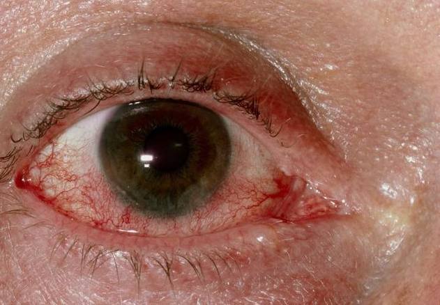 眼睛一出现4种情况,表明肝已受损,警惕是肝癌早期信号!