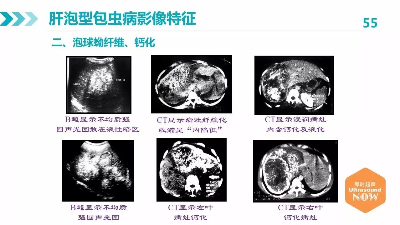 包蟲病的影像學特點