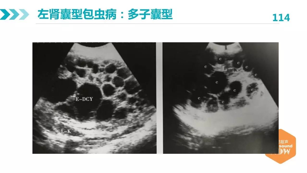 包虫病的影像学特点