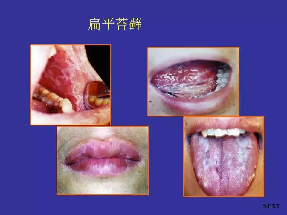 麻疹口腔黏膜柯氏斑图片