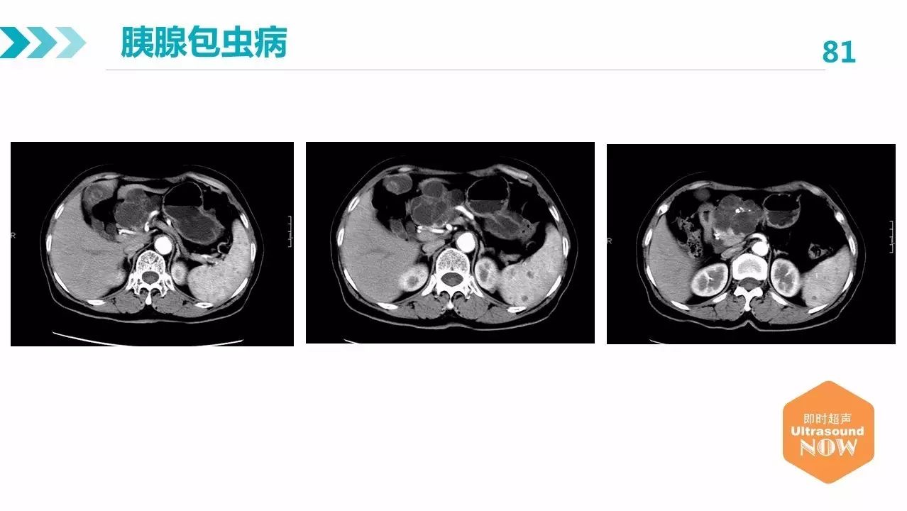 包虫病的影像学特点