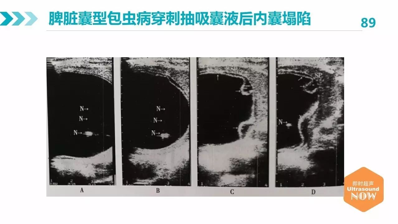 包虫病的影像学特点