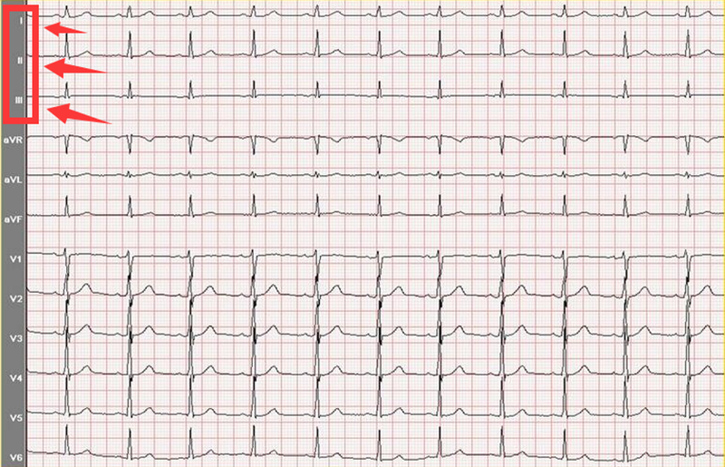 心电图正常t波图片