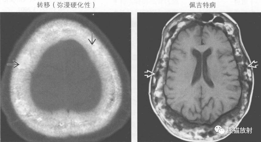 佩吉特氏病图片