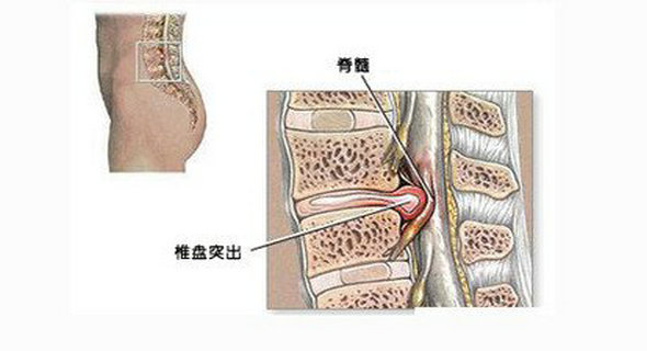 腰椎間盤突出你還在做無用功嗎耽誤治療危害大