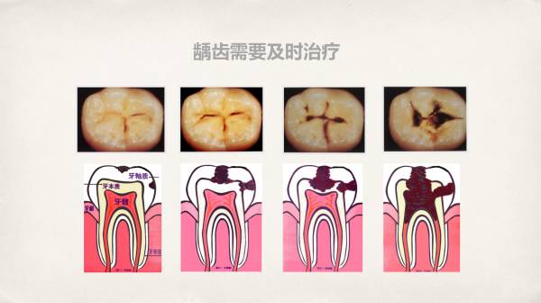 龋齿形成的原因图片