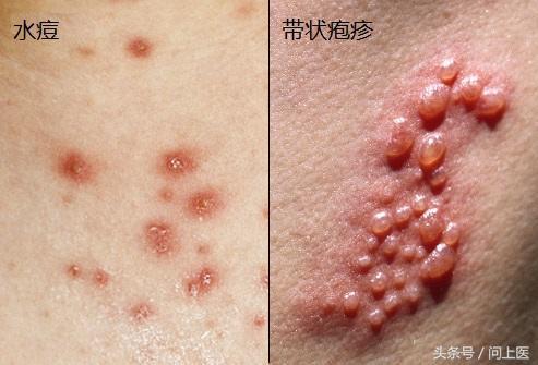 水痘和带状疱疹昆虫可能会引起有瘙痒感的水疱